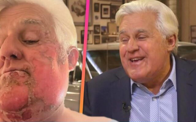 Jay Leno Shares About His Burn Injuries To His Face